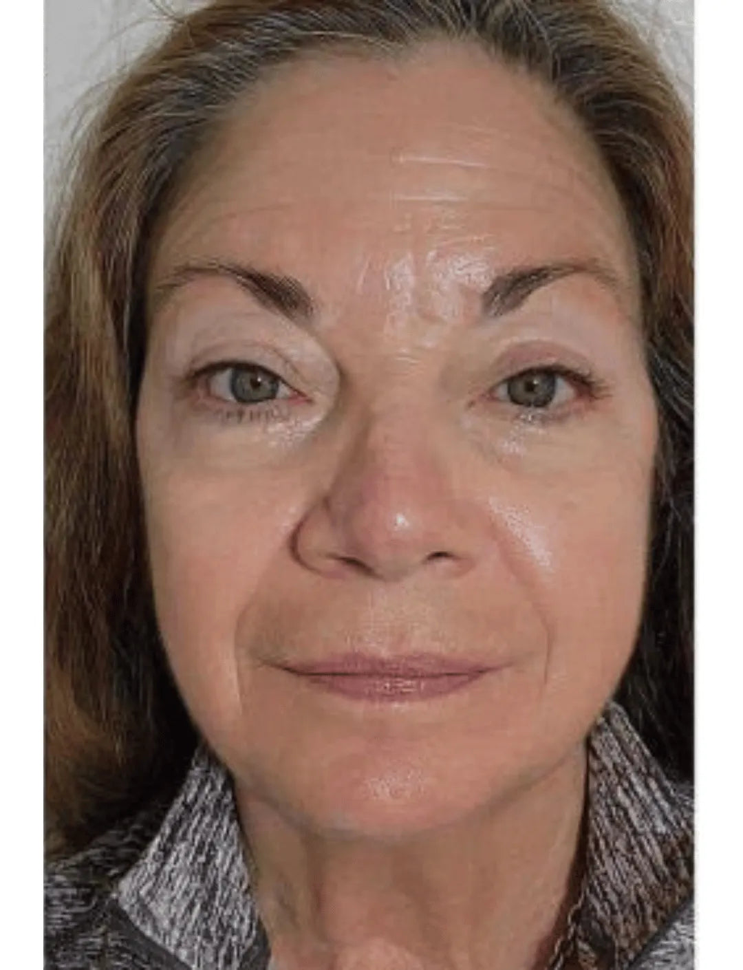 Combining ageLOC Tru Face Peptide Retinol Complex with ageLOC Tru Face Essence Ultra after 12 weeks